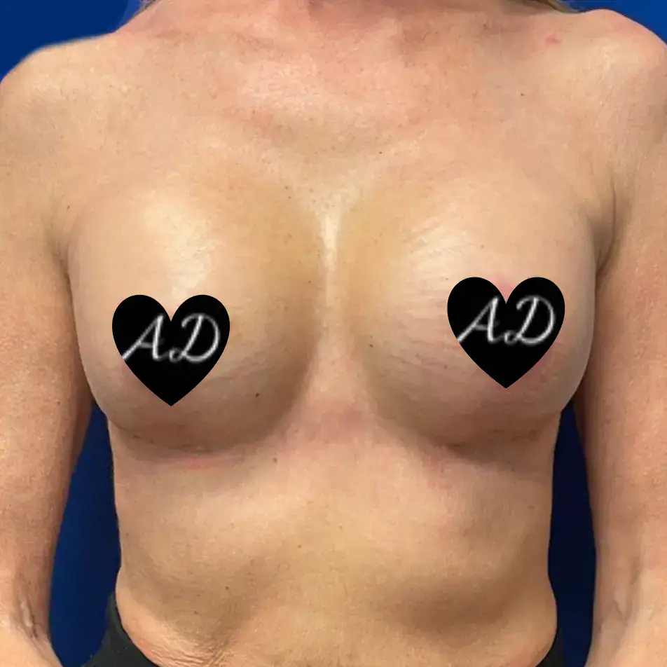 After - Case #3544: Breast Augmentation