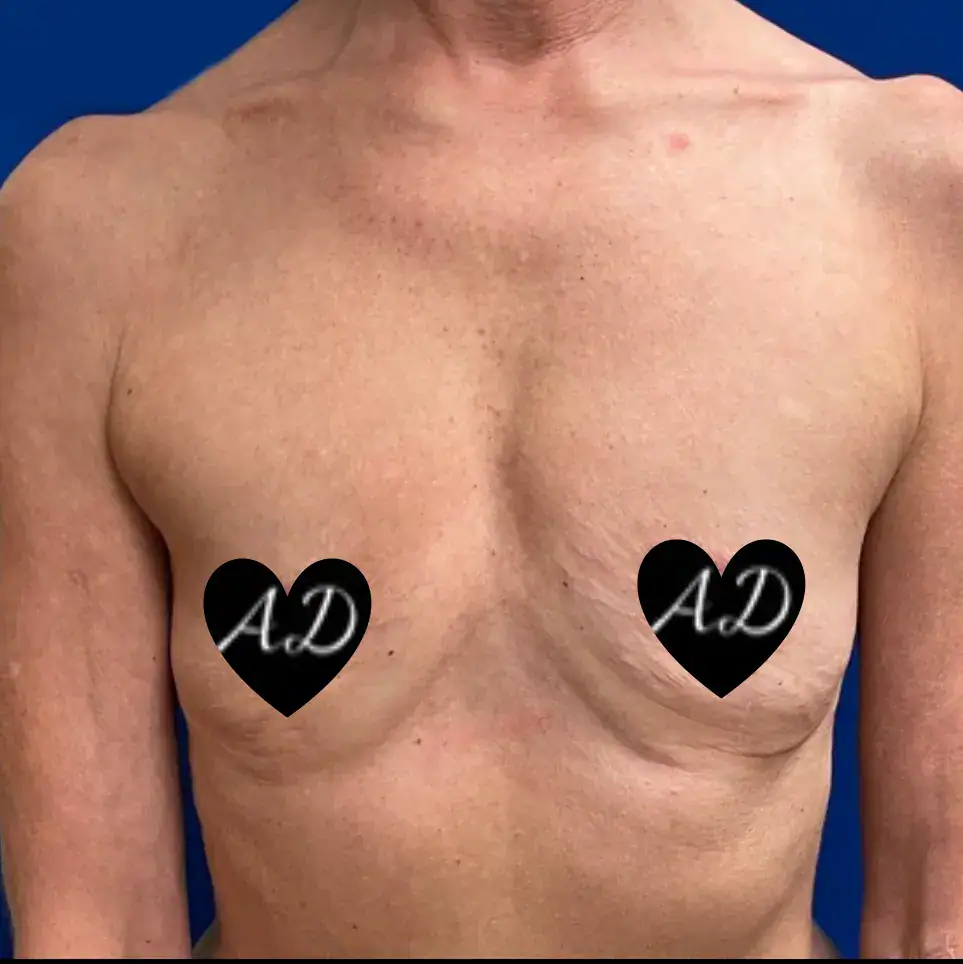 Before - Case #3544: Breast Augmentation