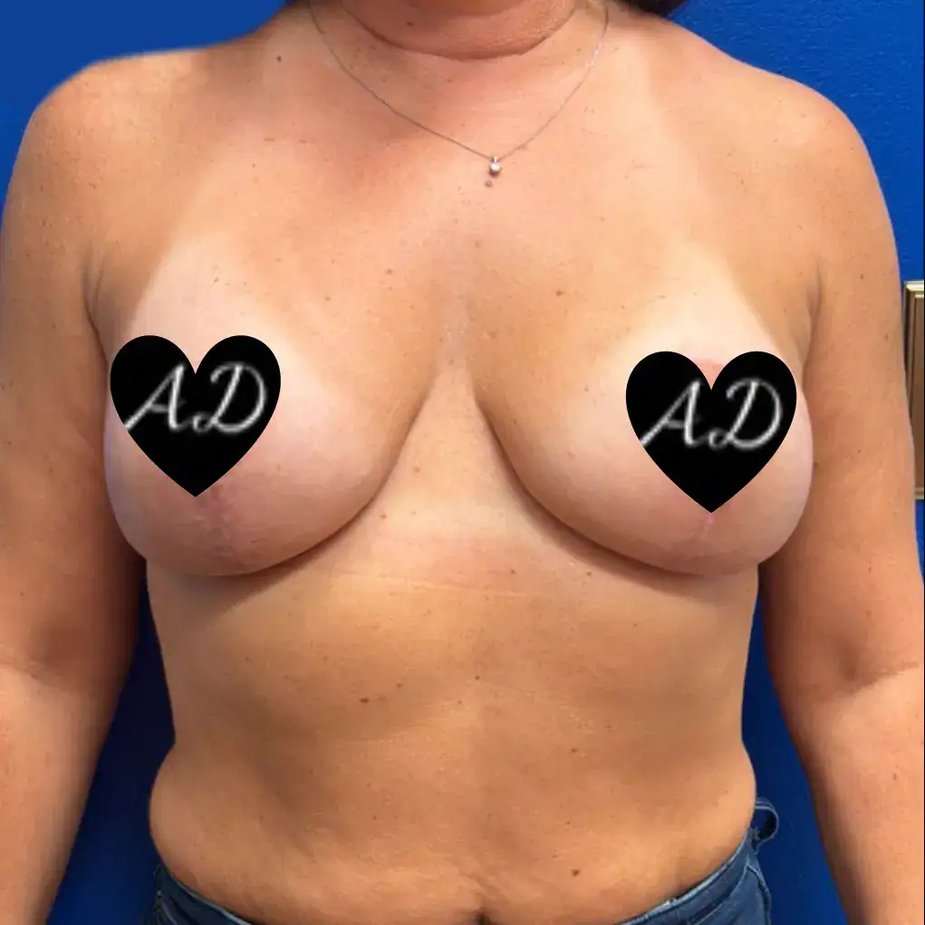 After - Case #3545: Breast Augmentation & Mastopexy