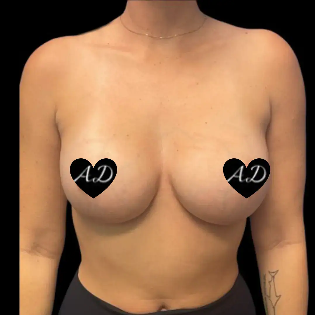 After - Case #3546: Breast Augmentation